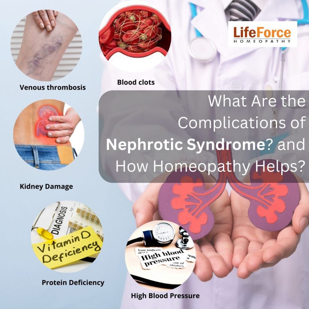 What Are the Complications of Nephrotic Syndrome? and How Homeopathy Helps?