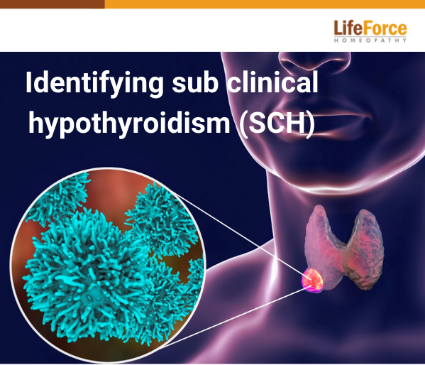 Identifying subclinical hypothyroidism (SCH)
