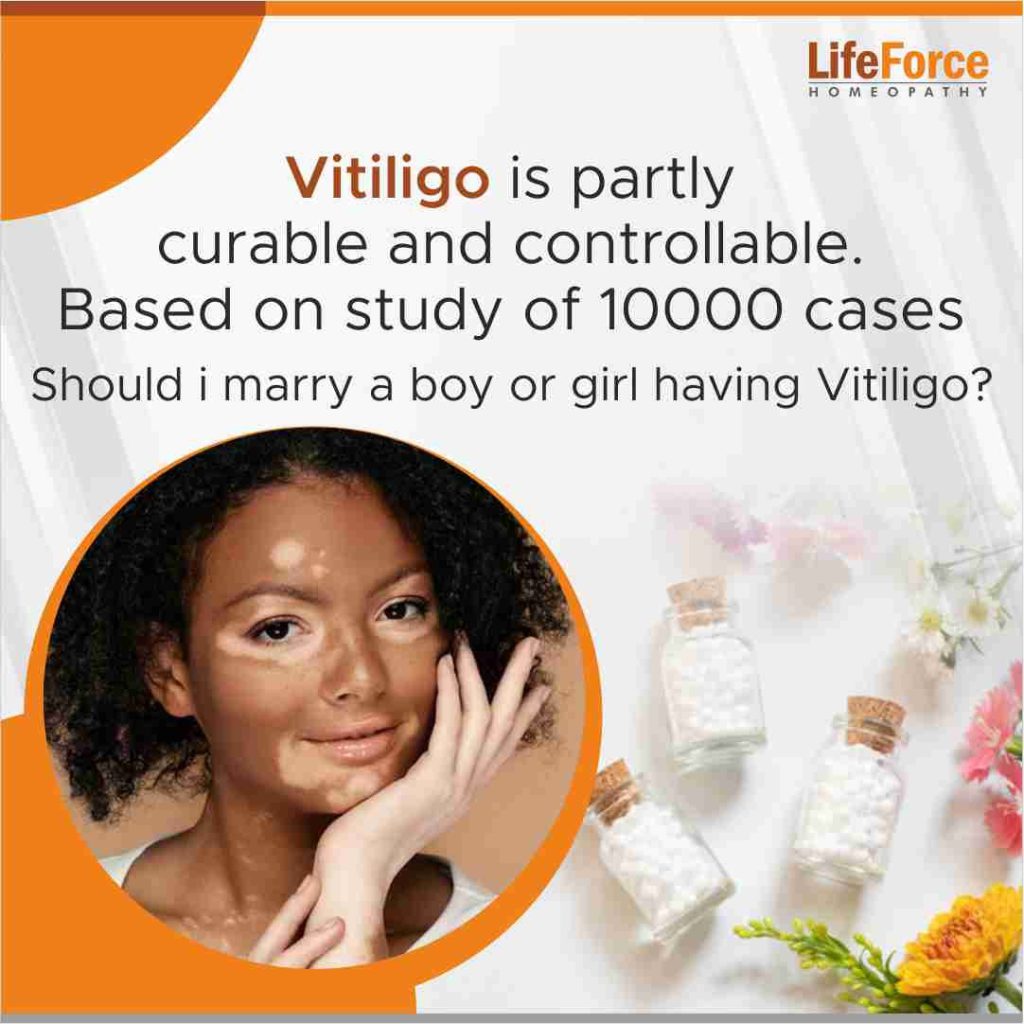 Should I marry a girl or a boy with Vitiligo?